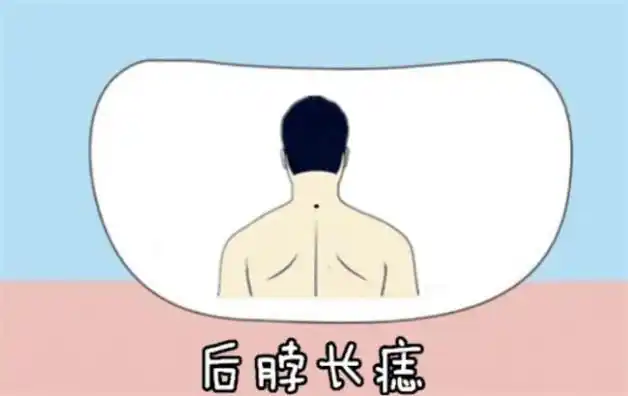 脖后痣当一个男人的脖子后面有痣,代表这个男人一生都会衣食无忧,在吃