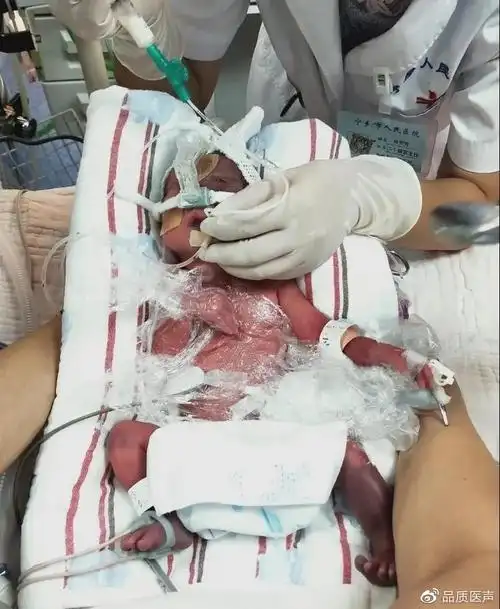 早产儿出生体重过低呼吸困难医院开展lisa技术成功抢治