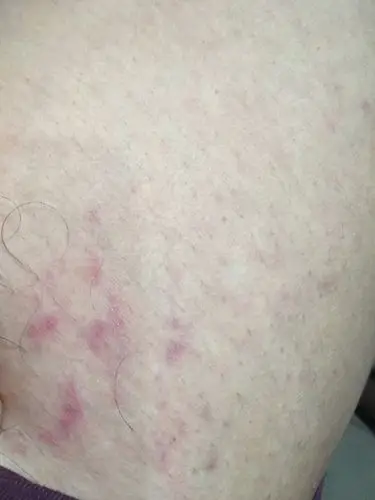 大腿根前面有红斑是怎么回事.不痛不痒.有没有知道的.是不是什么炎