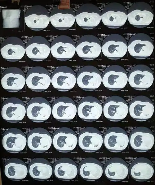 2020年复查的肺结核ct