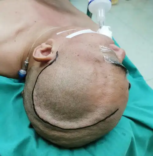 真实的颅骨修补术(成形术)_颅骨修补术_颅骨修补术治疗介绍 - 好大夫