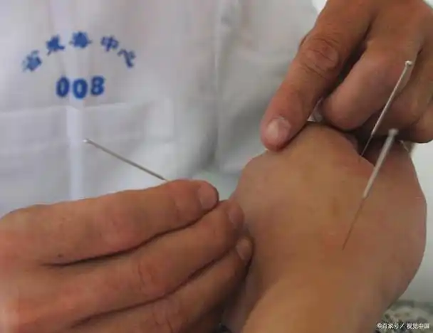 失眠扎针灸有效吗?