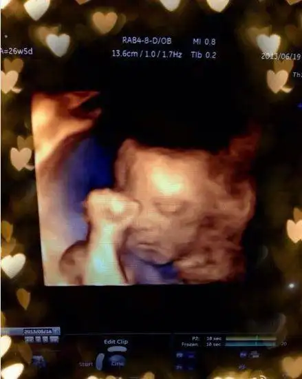 霍思燕怀孕8月晒胎儿b超照自拍学婴儿姿势卖萌
