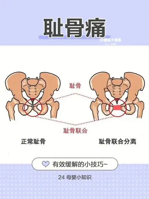 99耻骨在什么位置?出现原因?99如何才能缓解?