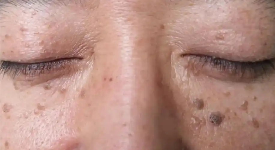 扁平疣和老年疣傻傻分不清