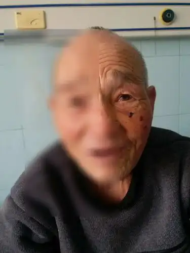 上颌窦占位,在二院粒子植入介入治疗后达到神奇般效果