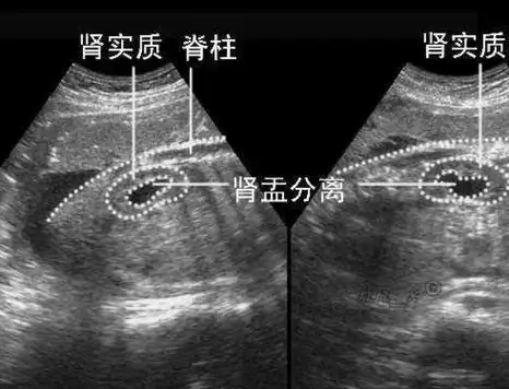 b超上的照片,教你怎么自己看孩子性别,大夫也是这样判断_胎儿_男孩