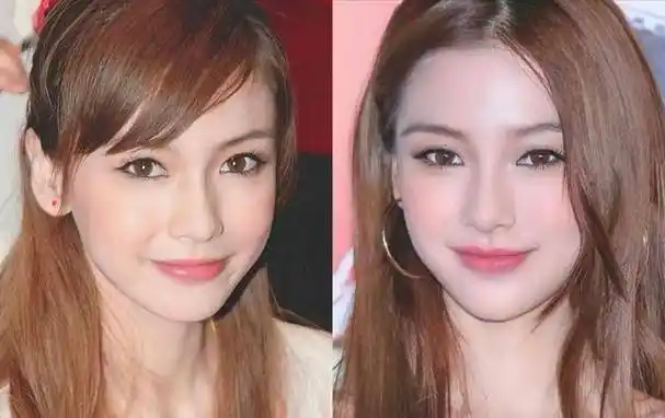 整形_西方_颧骨