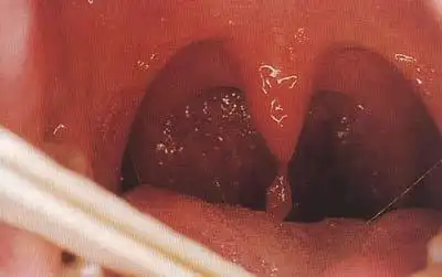 小舌头长了这个东西 我感觉像是不小心割破了小舌头 但不知道到底是不