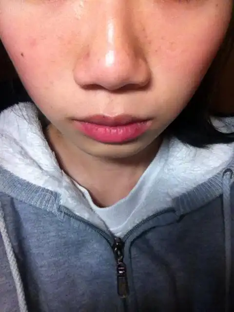 为什么鼻子(鼻梁发黑)和鼻周肤色明显不均匀?长出的"小粒粒"是什么?