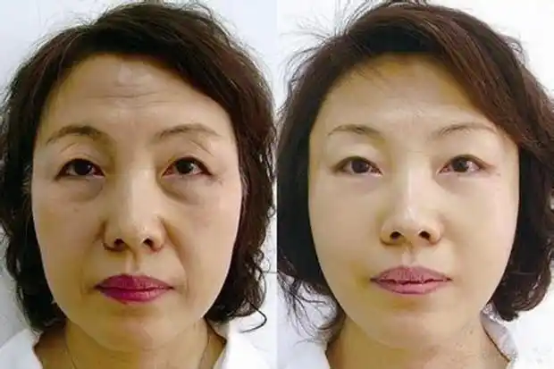 药店淘到"祛皱黑科技",90秒拉平脸部皱纹,满满的都是胶原蛋白