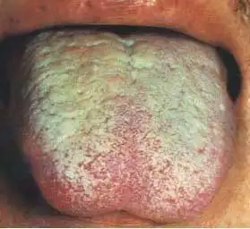 61张高清舌诊图谱,图文对照(珍藏版)_舌苔