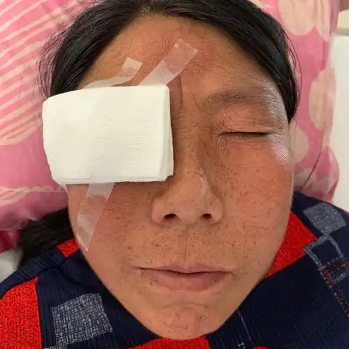 涂抹消炎眼膏后无菌纱布覆盖.