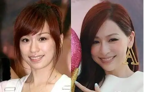 回顾王鸥变面瘫宁静扎900针,明星里的打针族,掀开娱乐圈遮羞布