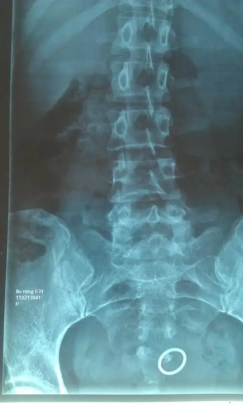 做弯腰动作时(如:洗碗,擦桌子等)时间稍微一长即可引起腰部酸胀不适