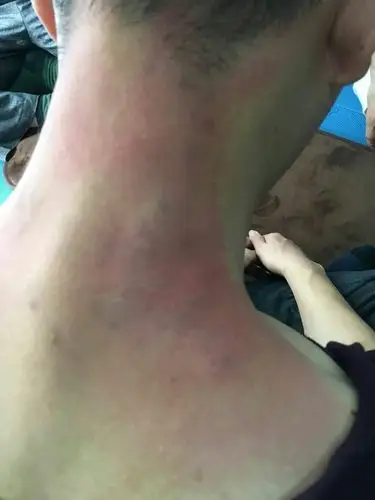 这也是如意棒拍出来的紫黑色毒痧,属体内毒素积滞,经络严重瘀堵,发炎