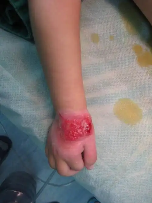 儿童手背植皮术后2年对比