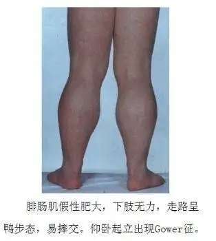 3岁韬韬小腿肌肉发达,但是医生却说