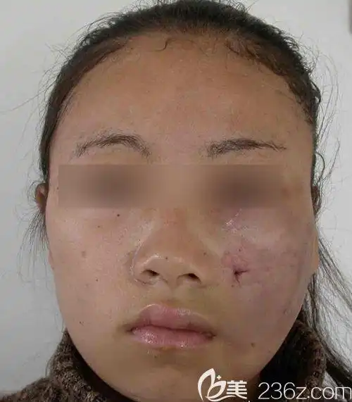 韩国明星为什么不做面部吸脂面吸有几个危害值得关注