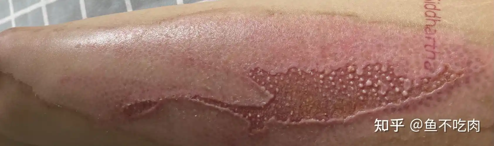 深二度烫伤恢复过程含图慎点