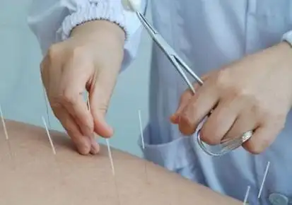 针灸治疗腰酸疼的秘诀