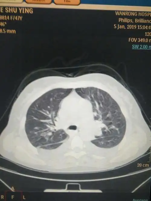 双侧胸腔积液,肺静脉系统也增粗,提示肺淤血.
