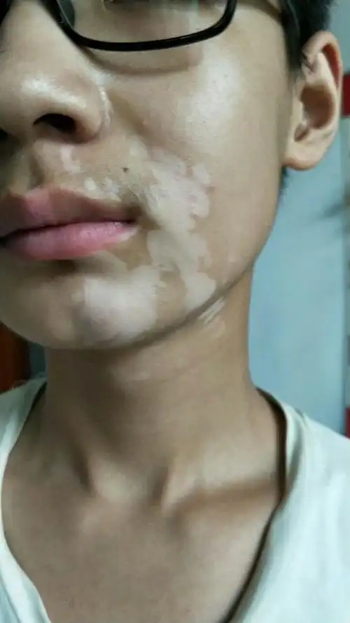 是一种常见多发的色素性皮肤病,是一种获得性或泛发性皮肤色素脱失症