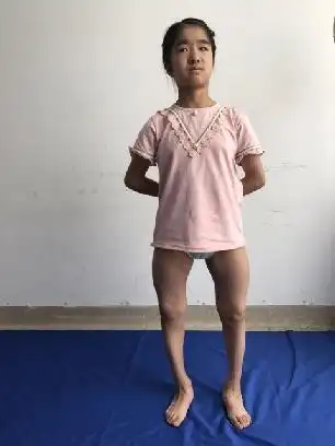 诊断:双下肢先天性"0"型腿畸形