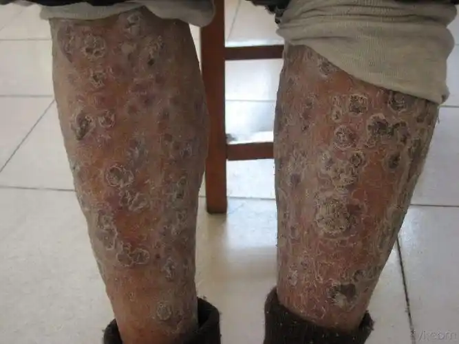 梅毒症状图片请问下这是梅毒的症状嘛?