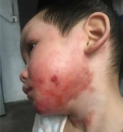 小孩烫伤后疤痕修复