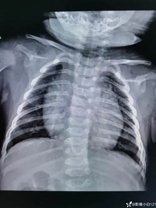 新生儿胸片各位老师帮忙看看