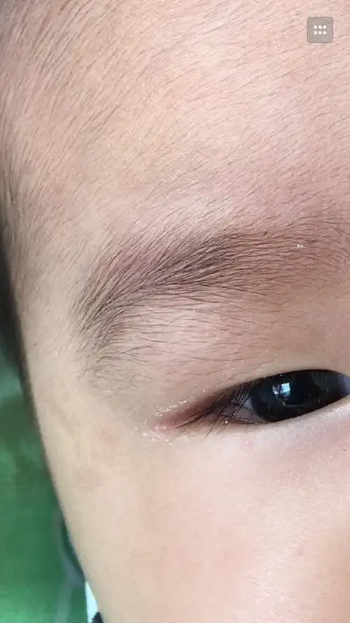 宝宝脸上突然长斑!