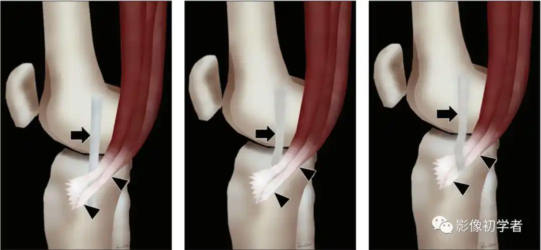 膝关节内侧副韧带损伤(二)