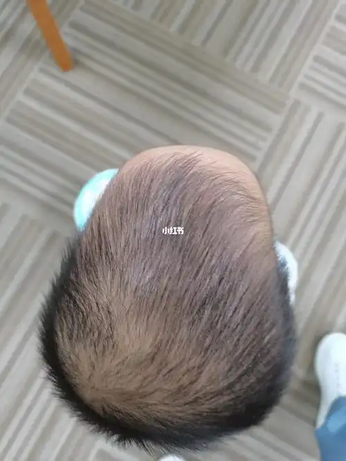 舟状头睡出小圆头,只需这样做_头型_定型枕_月子_婴儿枕_毛巾卷舟状