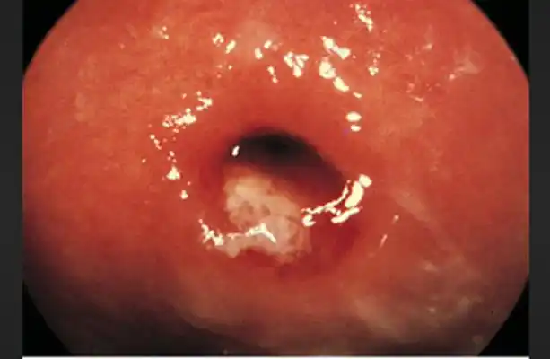 淋病的症状 (55)