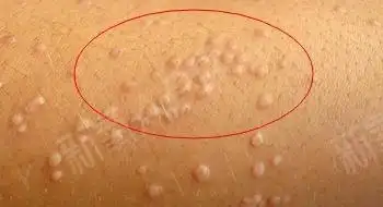 疣是由人类乳头瘤病毒引起的一种皮肤表面赘生物.