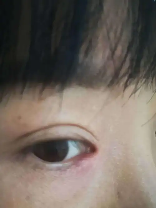 睑腺炎俗称麦粒肿中医名针眼的个人经验治疗