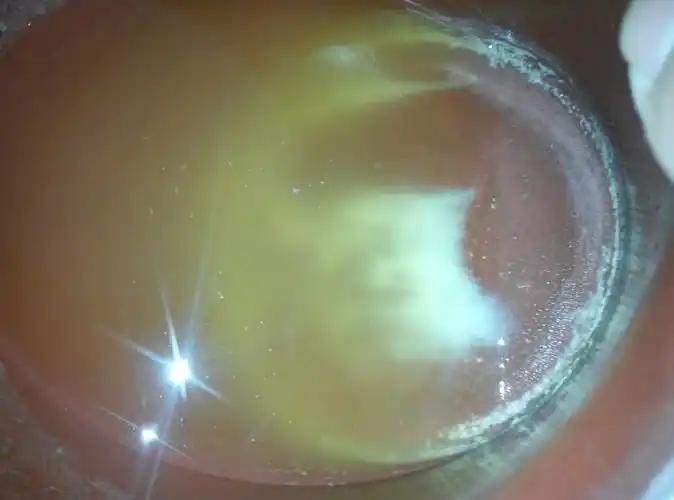 我生了孩子四十天左右,尿液变得非常浑浊,会沉淀白色物,像鼻涕一样的