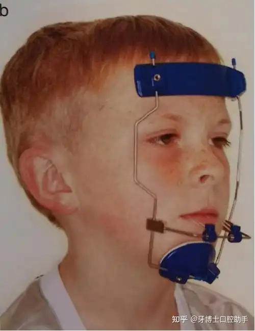 面罩前方牵引所以对于上颌骨骨性发育不足的患者来说,这个阶段真的