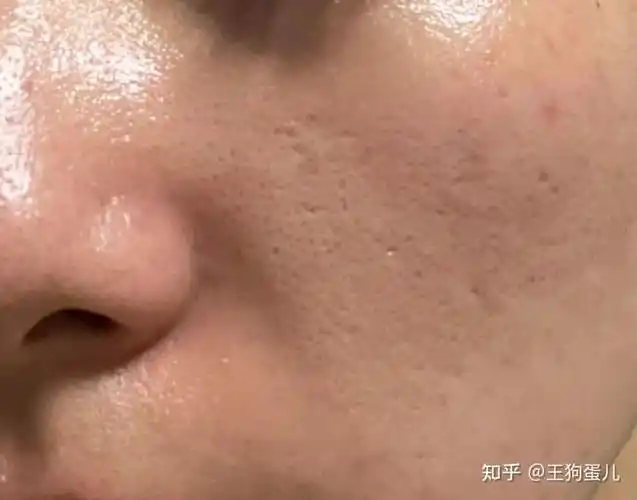 男生大油皮如何变清爽干净