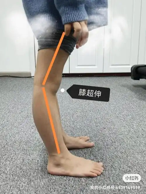 92书接上文9293膝关节反张的形成原因1,结构性异常这种属于天生