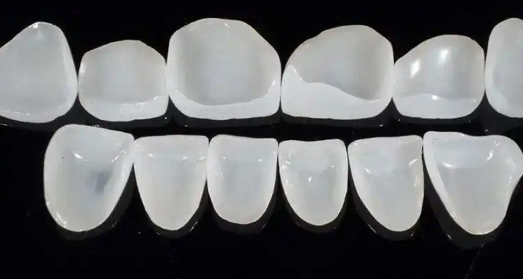 树脂贴面和瓷贴面有什么区别