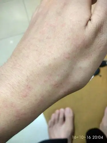 身体发热时手上和腿上会起很多小红豆密密麻麻的