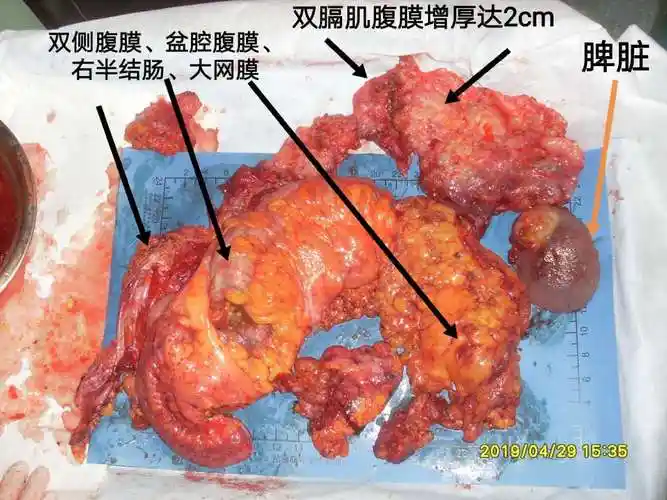 病例54-- pmp术后半年行规范的crs hipec - 好大夫在线