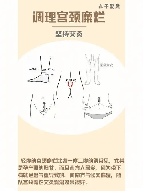 调理宫颈糜烂艾灸穴位