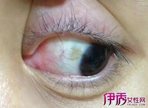 【图】眼睛黄斑病变严重吗 分享黄斑病的治疗方法