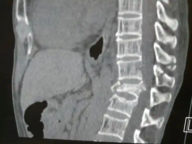 腰椎爆裂性骨折切开复位内固定术