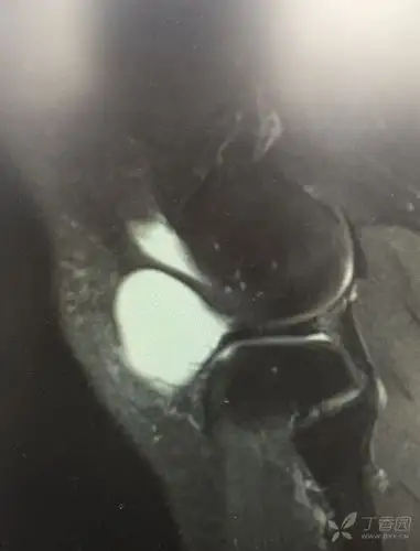 膝关节半月板囊肿?滑膜滑肿? [病例帖]