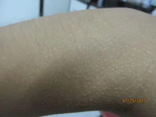 脖子和手上长了许多白色的小疙瘩,不痒,不是脂肪粒 怎么治啊