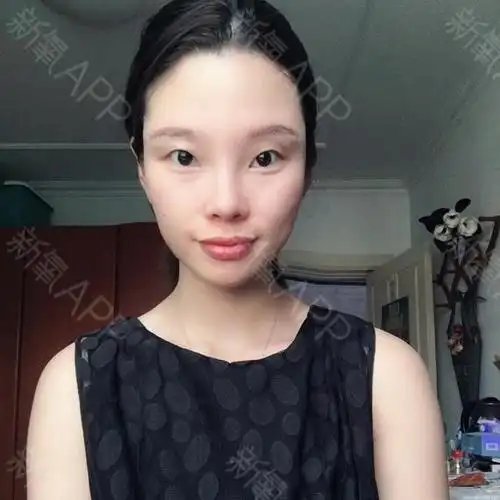 新氧- 王成毅 | 眼部 | 其他